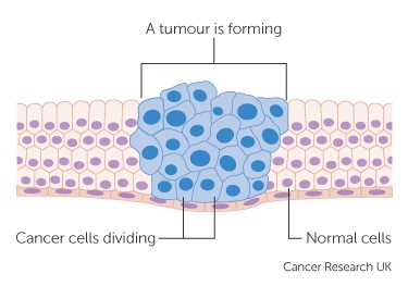 how cancer develops