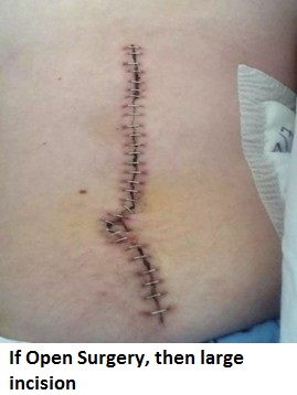 if-open-surgery-then-large-incision