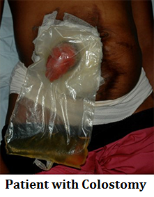 patient-with-colostomy