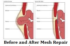 before-and-after-mesh-repair