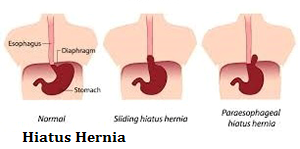 q-14-hiatus-hernia-1