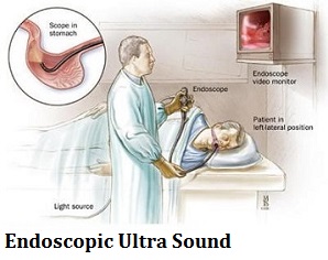 q-14-2-endoscopic-ultra-sound