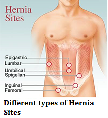 q-15-different-types-of-hernia-sites