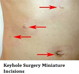 q-8-keyhole-surgery-miniature-incisions-2