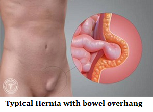 q1-typical-hernia-with-bowel-overhang-1