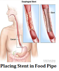 q11-placing-stent-in-food-pipe