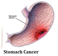 q12-stomach-cancer