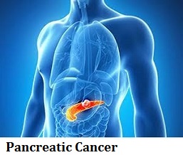 q18-pancreatic-cancer