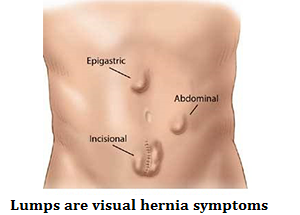 q2-lumps-are-visual-hernia-symptoms