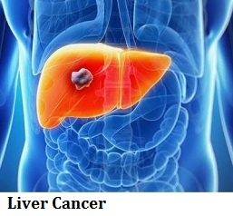 q21-liver-cancer