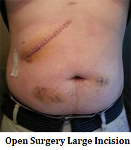 q5-1-open-surgery-large-incision