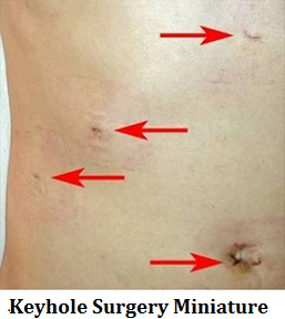 q5-2-keyhole-surgery-miniature-incision