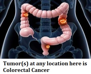 tumors-at-any-location-here-is-colorectal-cancer