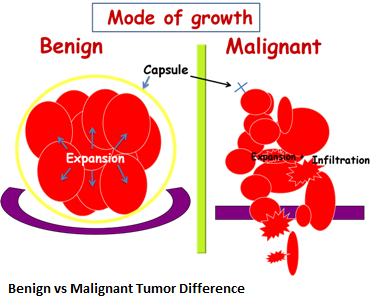 2-benign-vs-malignant-tumor-difference-new