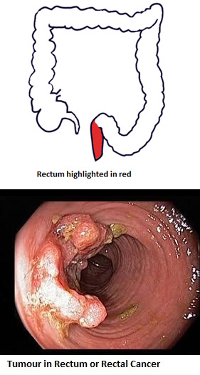 3-colostomy-opening-and-bag-to-collect-feces