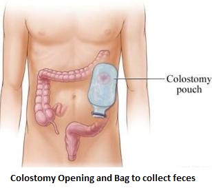 2-tumour-in-rectum-or-rectal-cancer