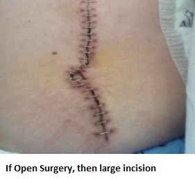 6-if-open-surgery-then-large-incision