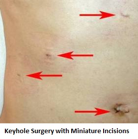 7-keyhole-surgery-with-miniature-incisions