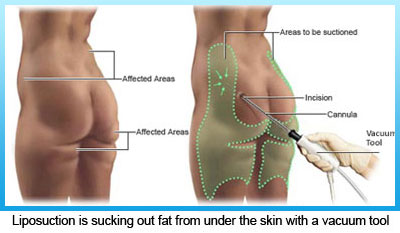 1-liposuction-is-sucking-out-fat-from-under-the-skin-with-a-vacuum-tool-1